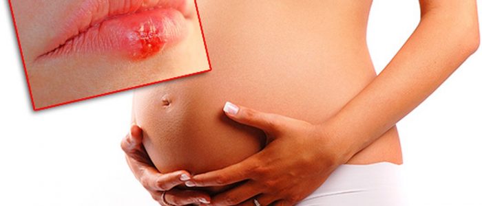 Герпес при беременности 1, 2, 3 триместры — лечение, чем опасен