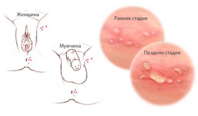 Вирус герпеса: возбудители, симптомы, причины и лечение